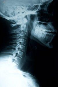 Car and Body: Common Neck Injuries