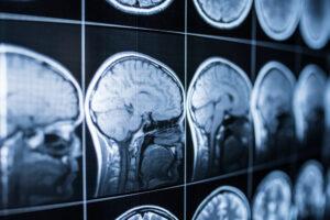 Which Types of Accidents Can Lead to Brain Injuries